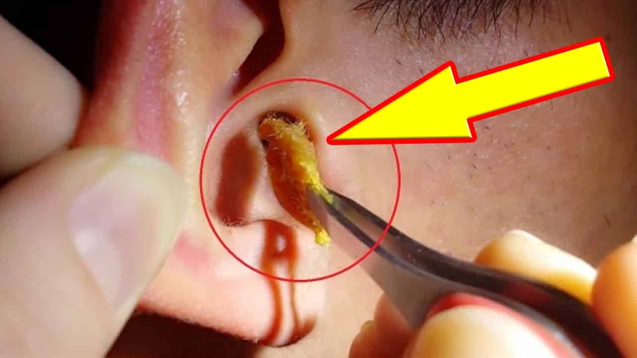 Kulak Kiri Nasıl Temizlenmelidir?