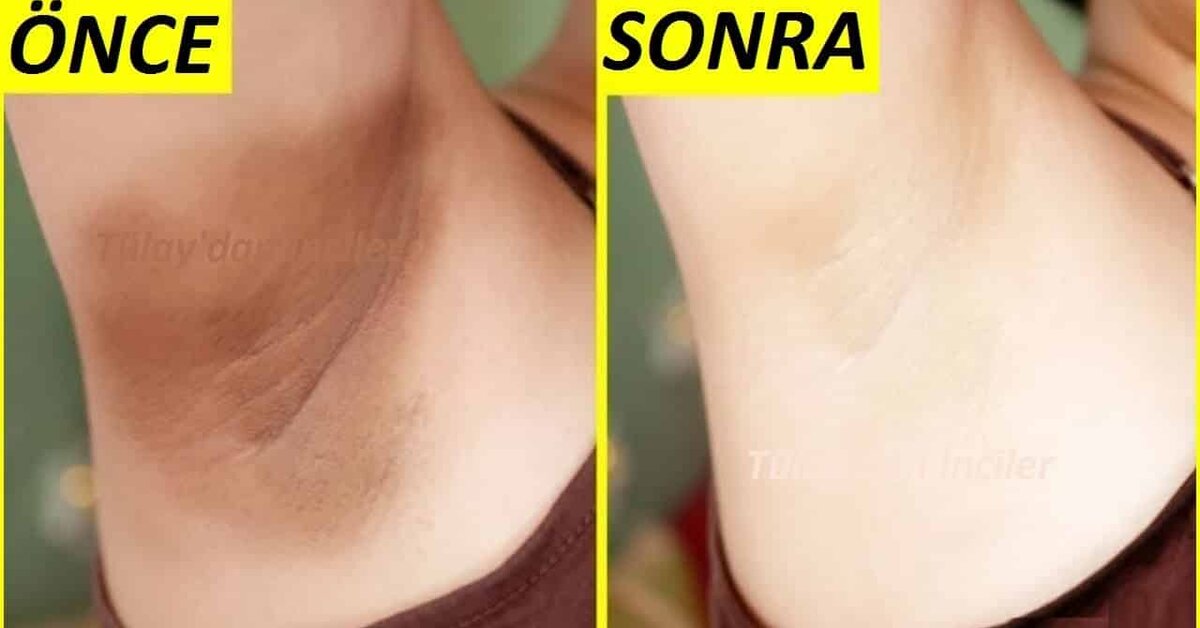 Kararmış Koltuk Altı ve Bikini Bölgesi Nasıl Beyazlatılır?