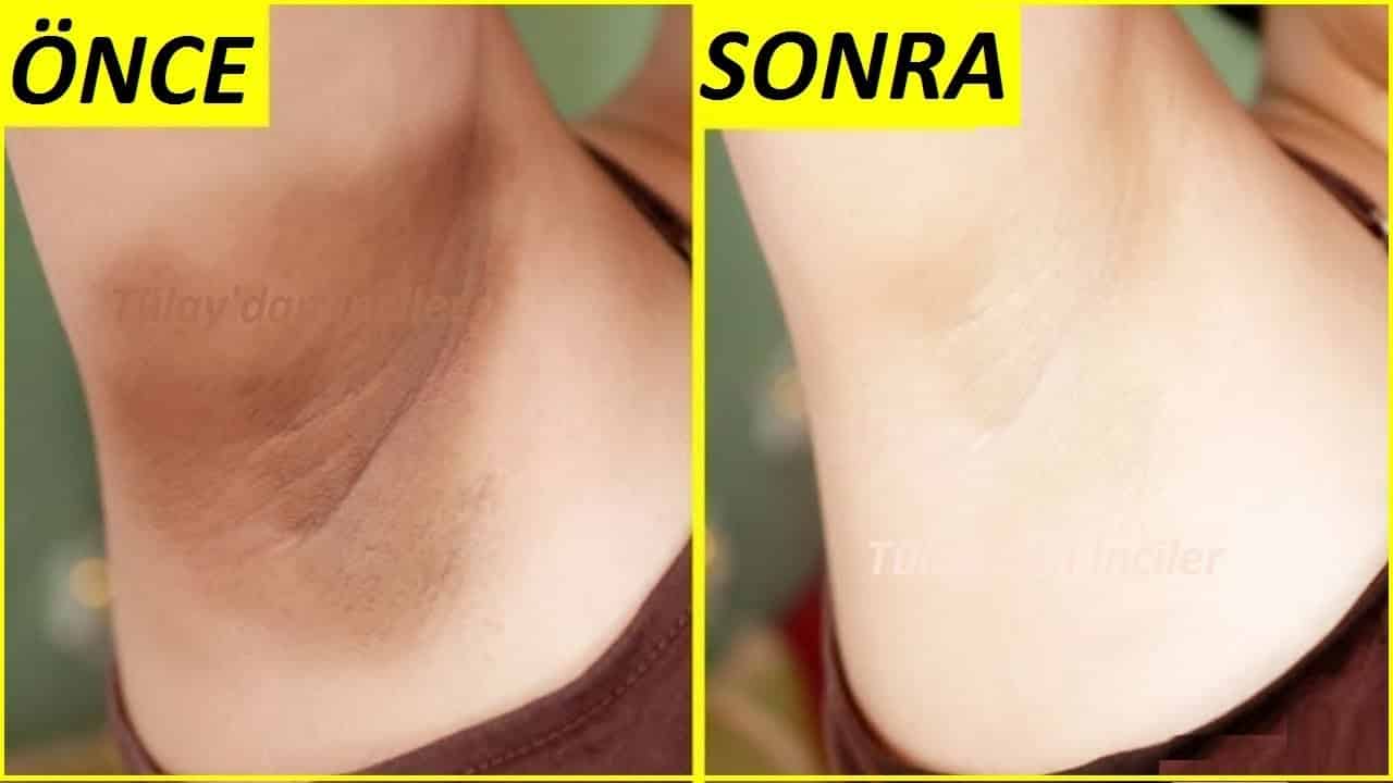 Kararmış Koltuk Altı ve Bikini Bölgesi Nasıl Beyazlatılır?