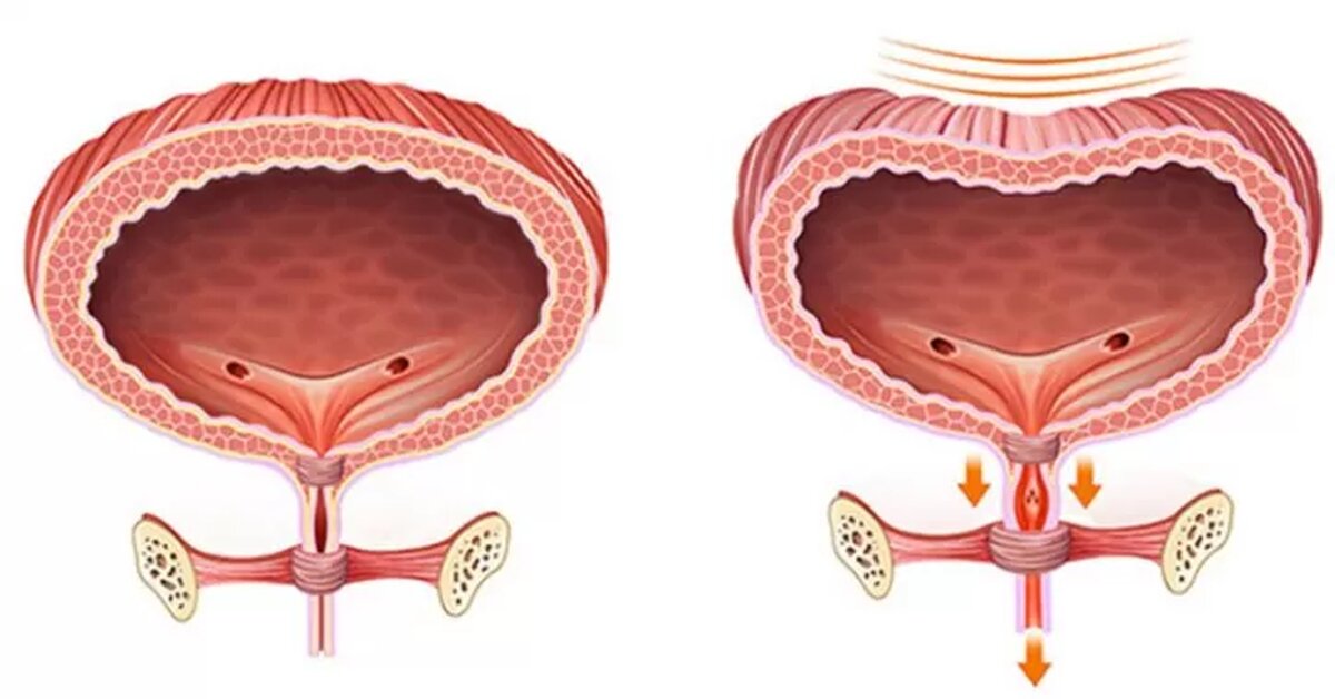 Mesane Fonksiyon Bozukluğu Nedir ve Belirtileri Nelerdir?
