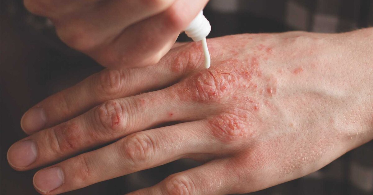 Sedef Hastalığına Mucize Tedavi