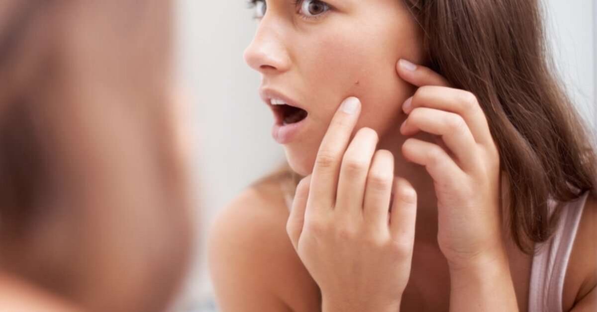 Sivilce Oluşum Nedenleri? Sivilce Tedavisi?