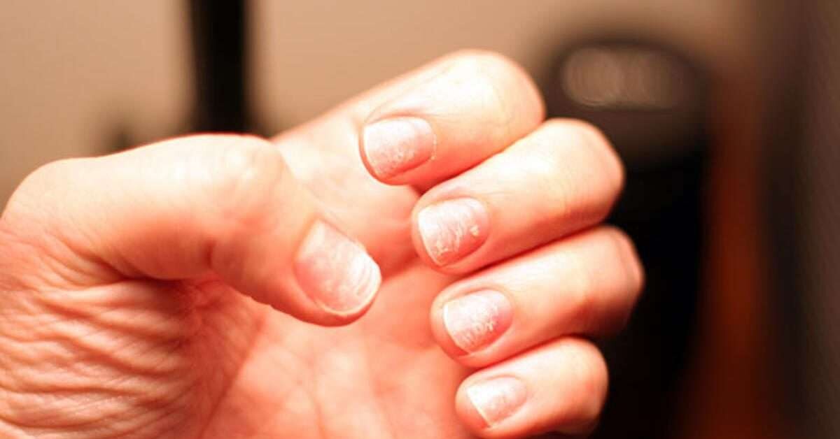 Tırnaklarınıza Bakarak Hastalığınızı Öğrenin!