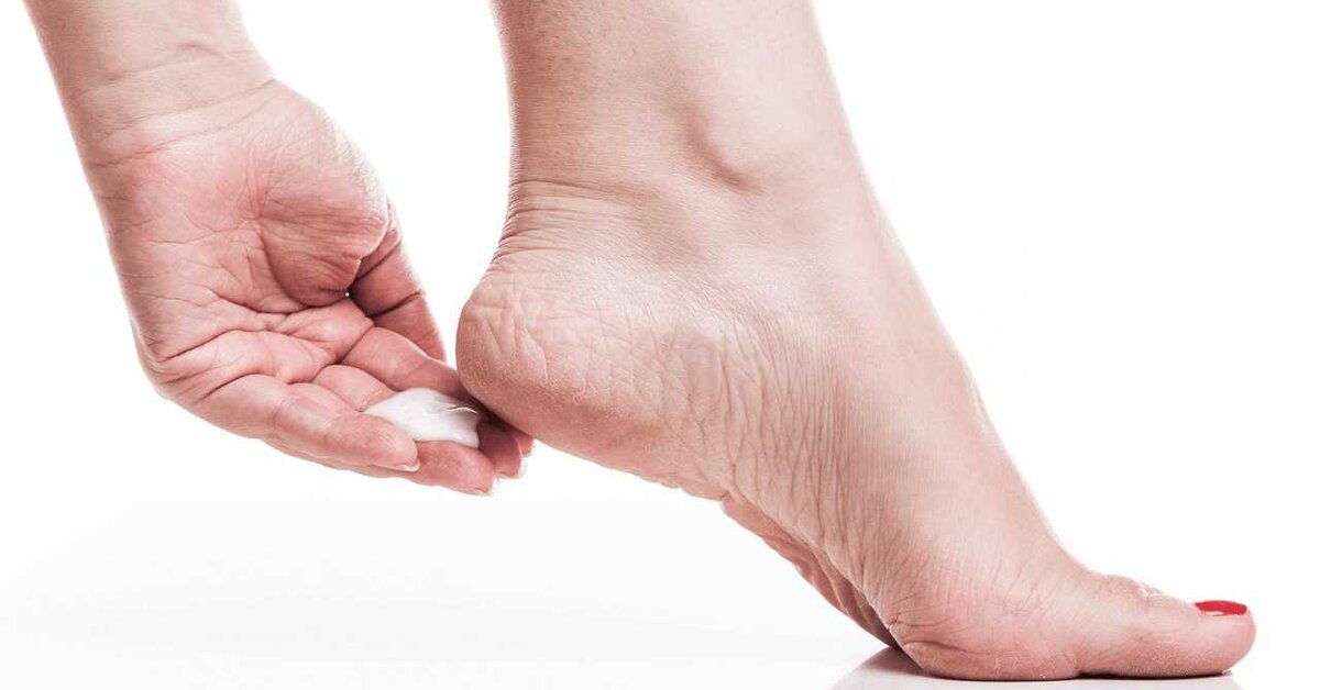 Topuk Çatlaklarına Doğal Çözüm