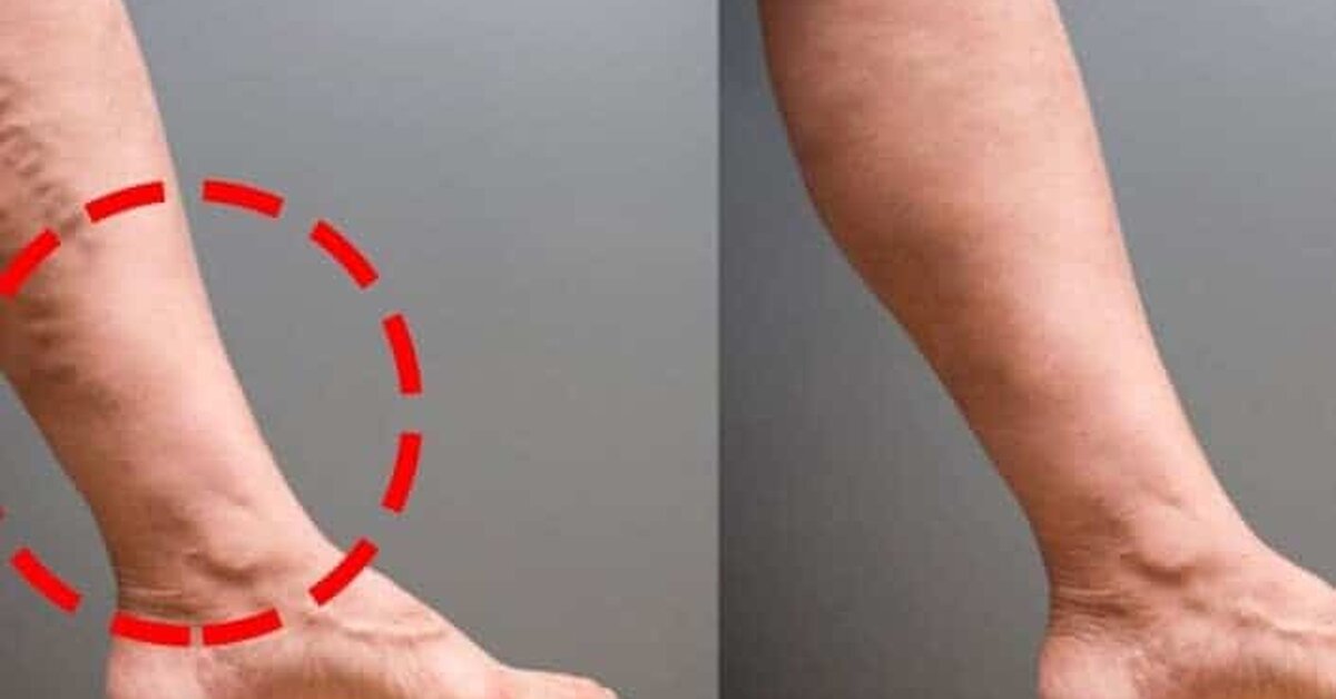 Varisli Damarlar ve Tromboz için Sadece 2 Basit Maddeyle Doğal Çözüm!