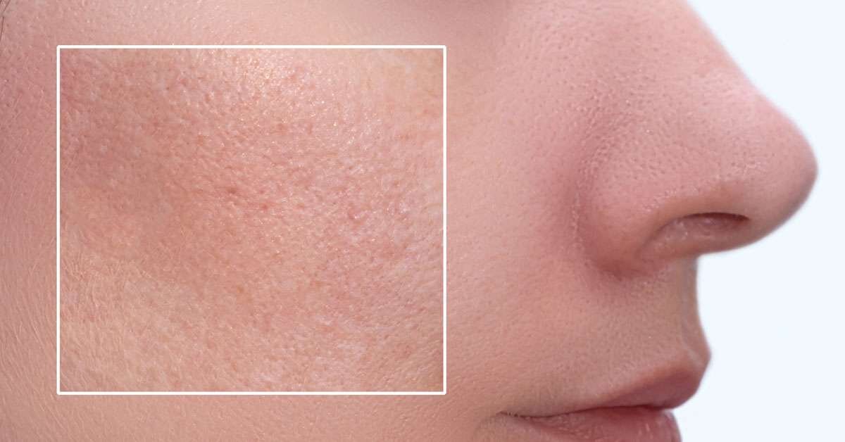 Yağlı Ciltlere Cilt Bakımı Nasıl Yapılmalı?