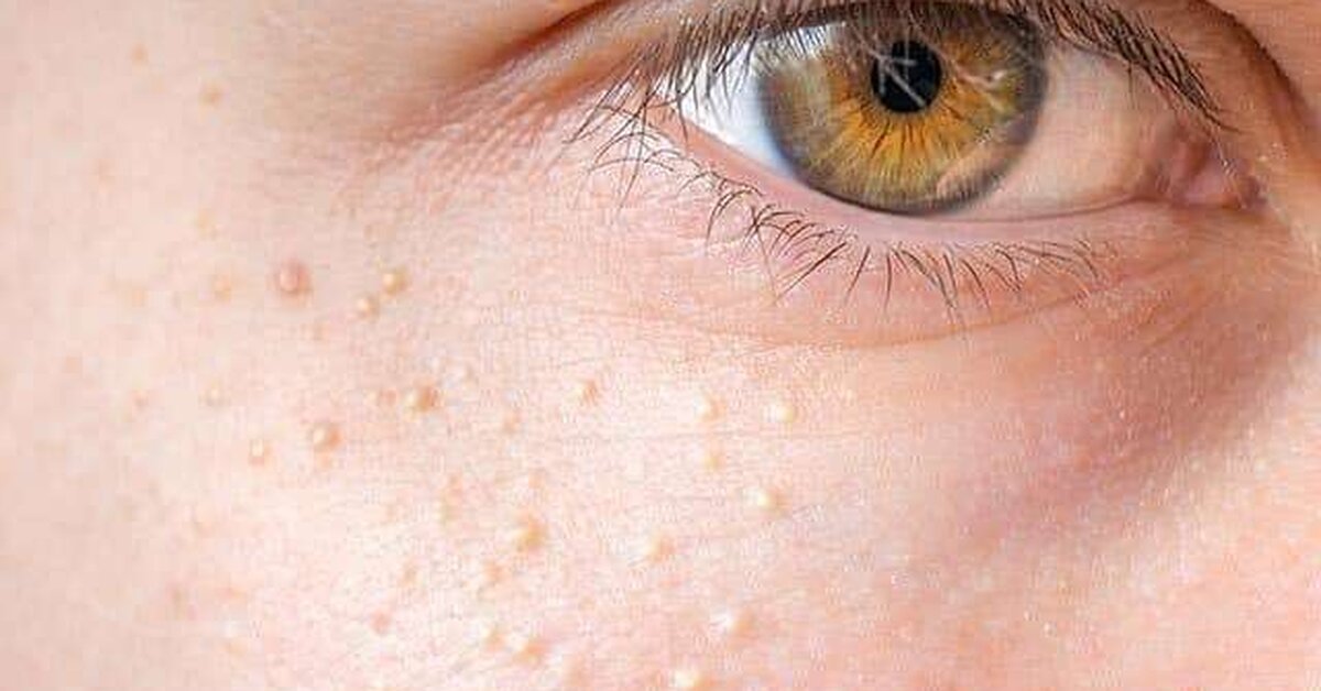 Yüzde Çıkan Yağ Bezeleri Nasıl Yok Edilir?