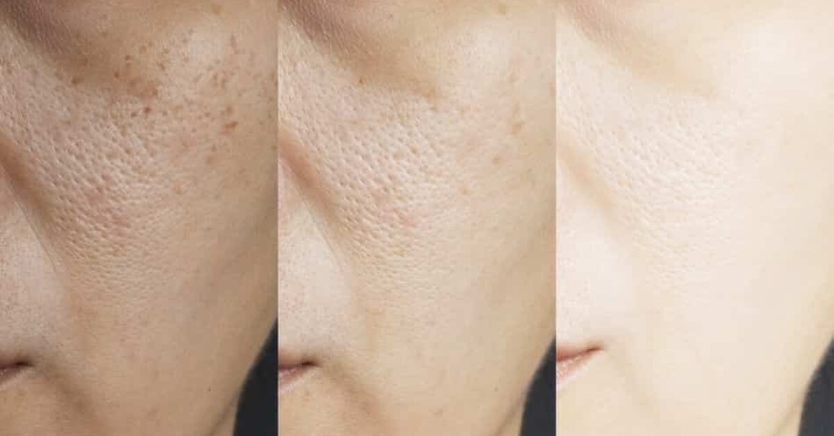 Yüzde Oluşan Delik ve Çukurlar Nasıl Geçer?