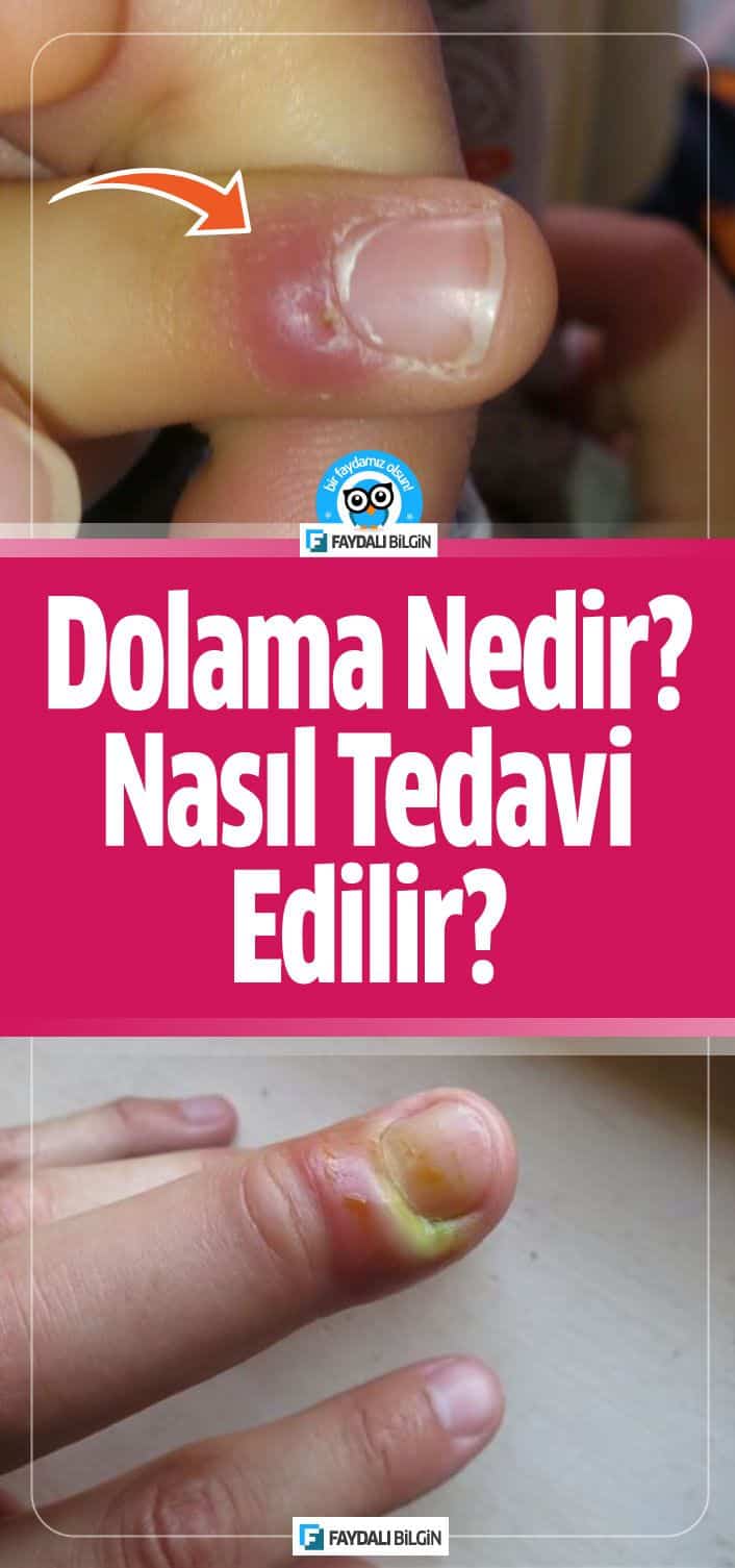 Dolama nedir? Dolama Nasıl Tedavi Edilir? Kesin Çözüm!