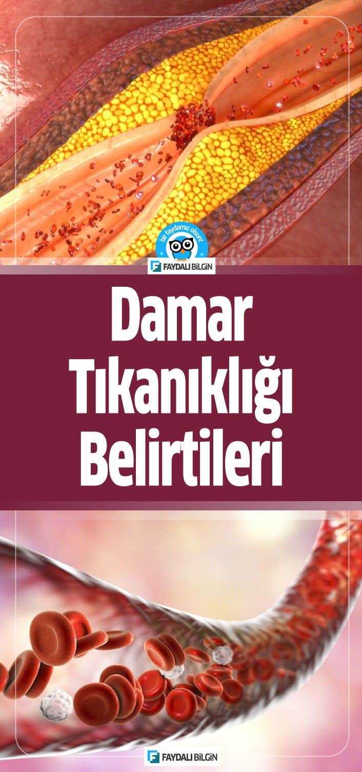 Damar Tıkanıklığı Belirtileri? Damar Tıkanıklığı Nedenleri? Damar Tıkanıklığı Tedavisi Nasıl Yapılır? Damar yoluyla kalbe beslenme sağlanmaktadır. #damar #damartıkanıklığı #hastalık #belirtileri #sağlık