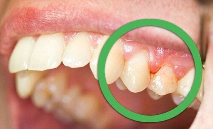 Diş Hekiminizin bilmenizi istemediği 12 Doğal Diş Ağrısı Tedavi Yöntemi