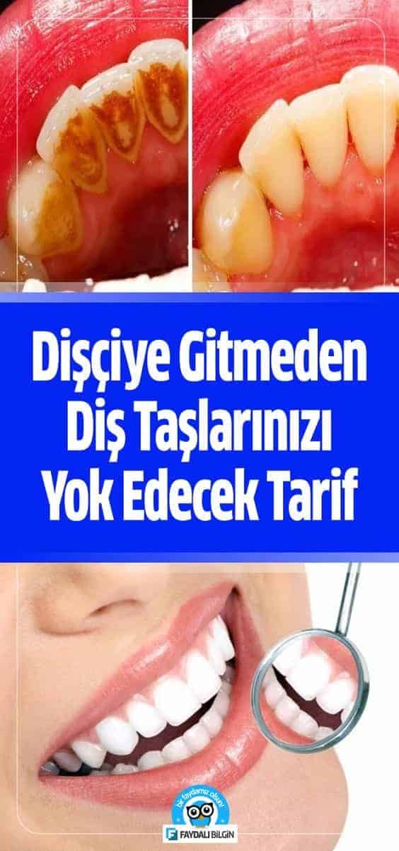 Dişçiye gitmeden diş beyazlatma yöntemleri birçok insanın en çok değer verdiği konuların başında gelmektedir. #diş #dişler #dişçi #diştaşları #tartar #dişsağlığı #dişbeyazlatma
