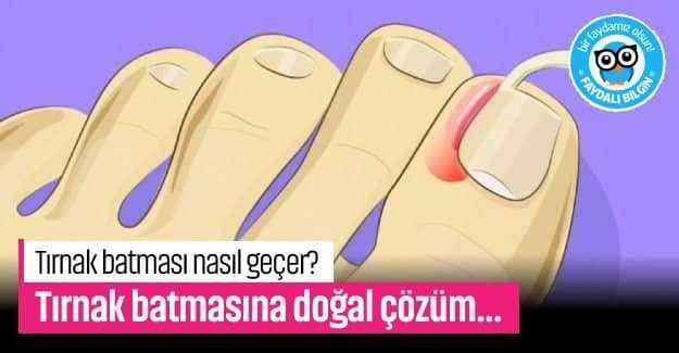 Tırnak batması nasıl geçer? Tırnak batmasına doğal çözüm...