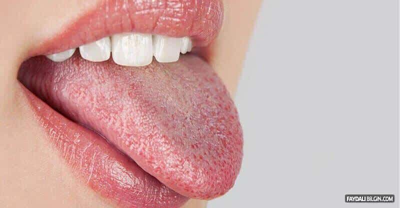 ağız kuruluğu (xerostomia)