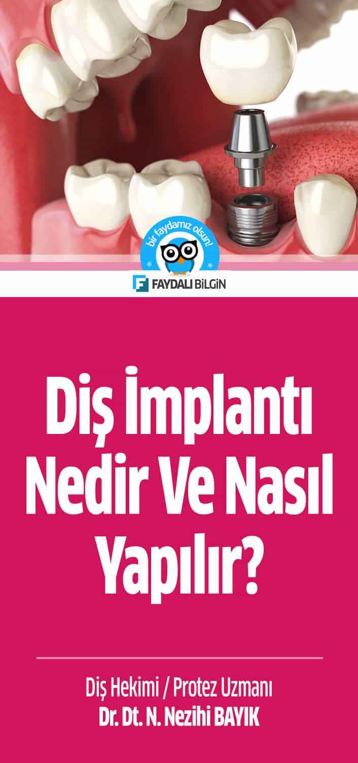 Diş implantı nedir ve nasıl yapılır?