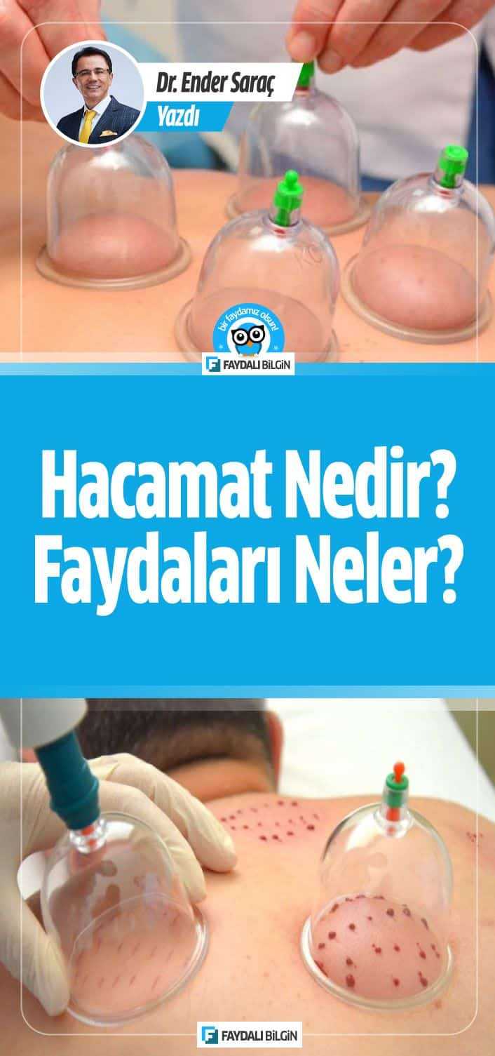 Hacamat Nedir? Hacamatın Faydaları Nelerdir?