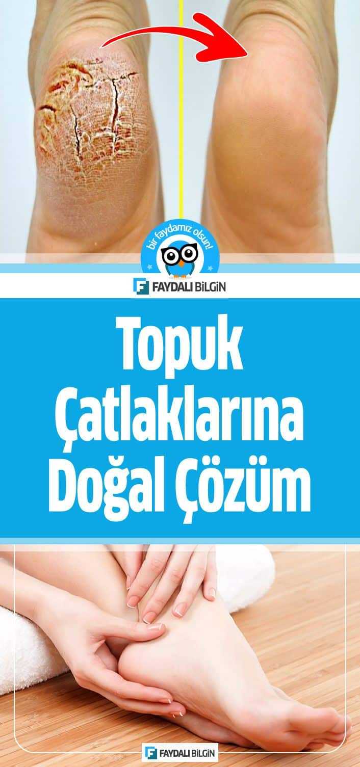 Bugün topuk çatlaklarına Doğal Çözüm tarifi veriyorum. Bu doğal karışım ile ayak mantarını azaltacak ve yumuşak topuklara sahip olacaksınız.