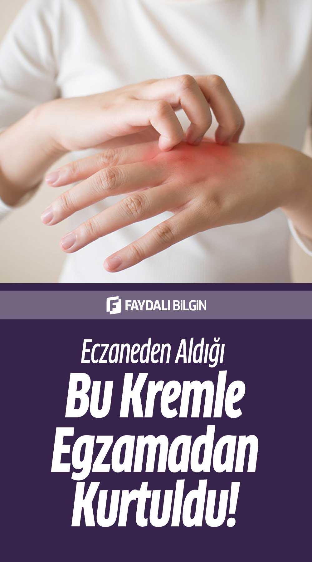 eczaneden aldığı kremle egzamadan kurtuldu!