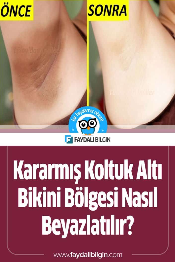 Kararmış Koltuk Altı ve Bikini Bölgesi için evinizde uygulayabileceğiniz kararmış bölgeleri beyazlatma tarifini sizin için hazırladık. #kararmış #koltukaltı #bikini #bikinibölgesi #beyazlatma #kadın