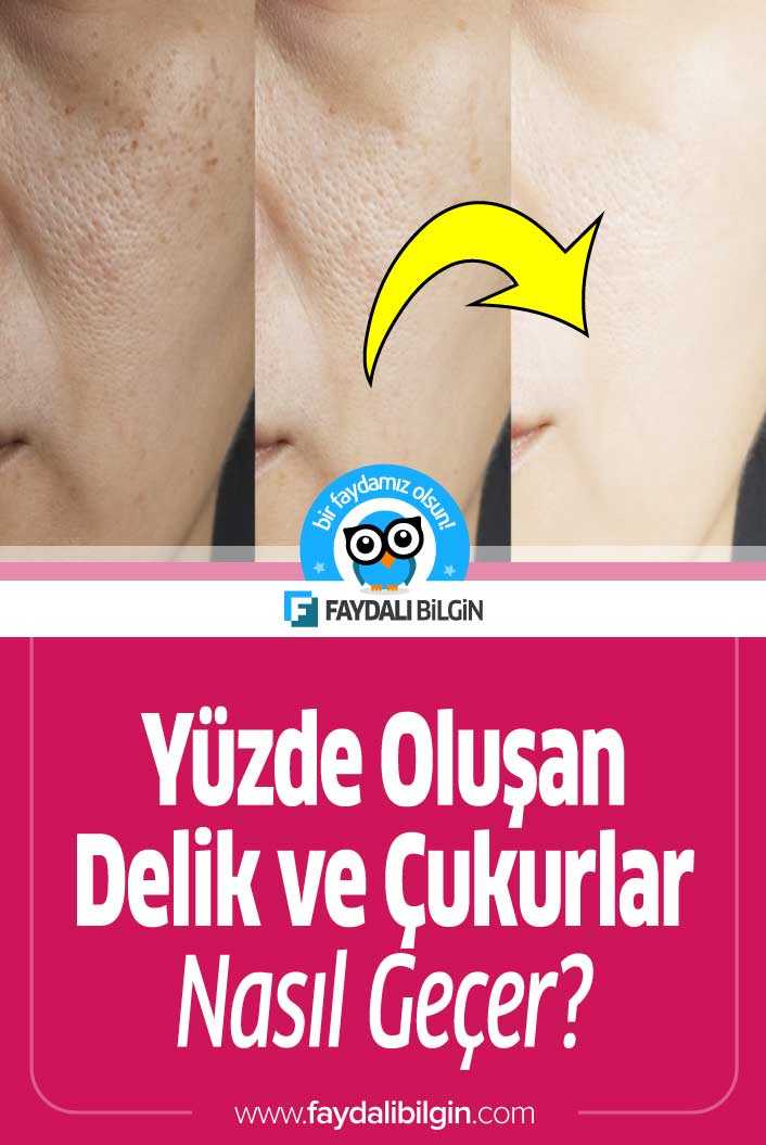 Yüzde Oluşan Delik ve Çukurlar Nasıl Geçer?