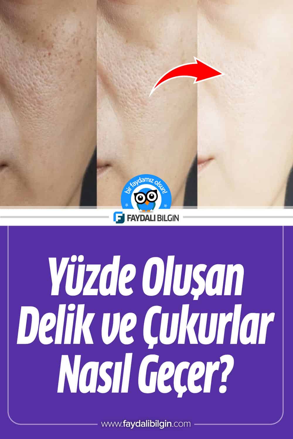 Yüzde Oluşan Delik ve Çukurlar Nasıl Geçer?