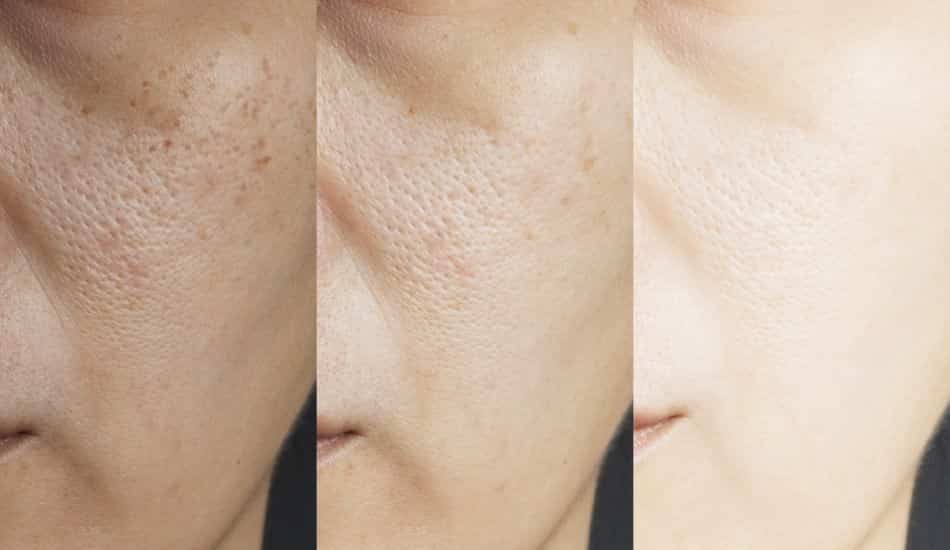 Yüzde Oluşan Delik ve Çukurlar Nasıl Geçer?