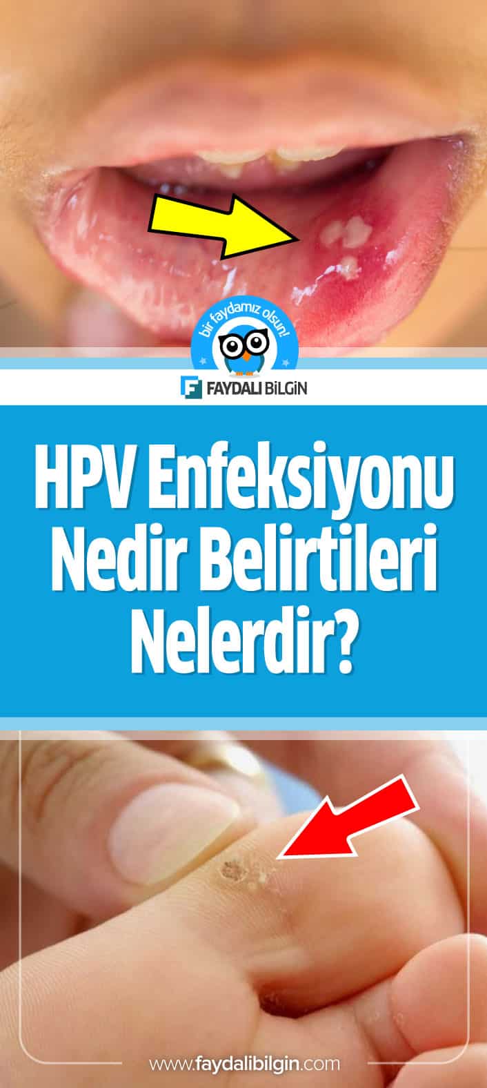 hpv enfeksiyonu nedir belirtileri nelerdir