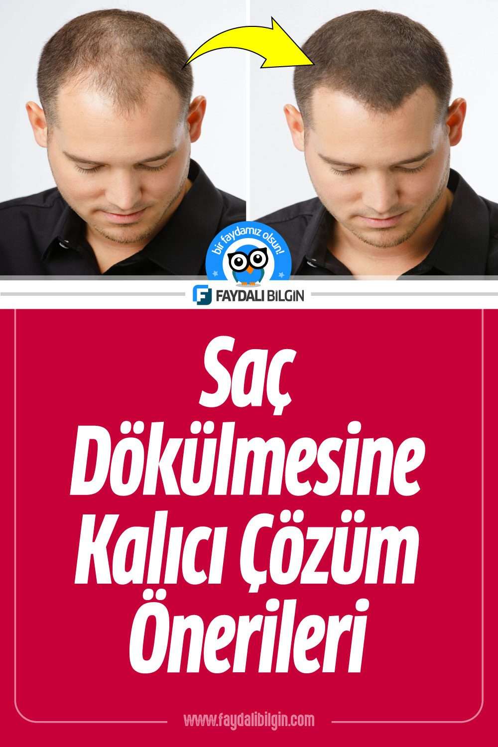 saç dökülmesine kalıcı çözüm