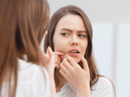 Ergenlik döneminde sivilce nasıl geçer?